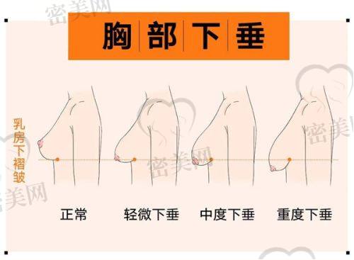 打玻尿酸能维持多久？别着急，有妙招