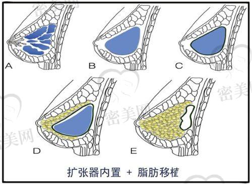 8月打玻尿酸优惠医院大揭秘