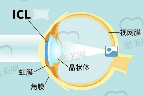 何氏眼科分院价格对比：北京、沈阳、重庆等地近视手术费差异明显