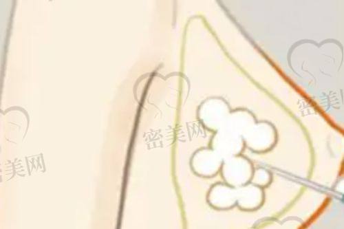 太原美媛荟整形美容医院——朱志荣医生主刀