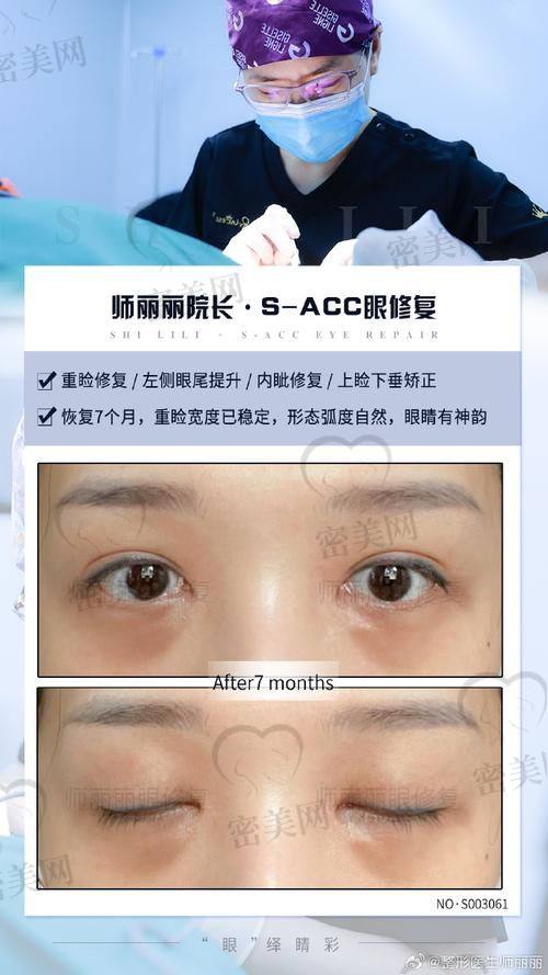 吴焱秋医生做双眼皮修复专精能力如何