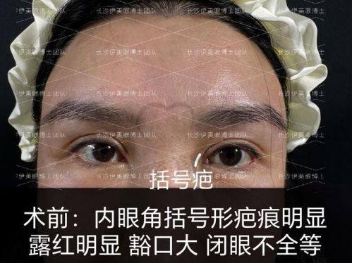 联合丽格吴焱秋修复双眼皮有哪些成功实例？
