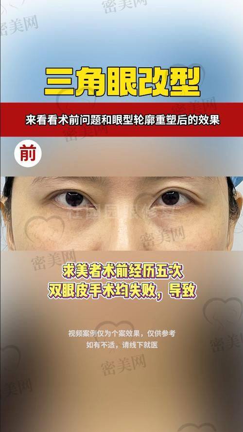 联合丽格吴焱秋修复双眼皮收费标准如何？
