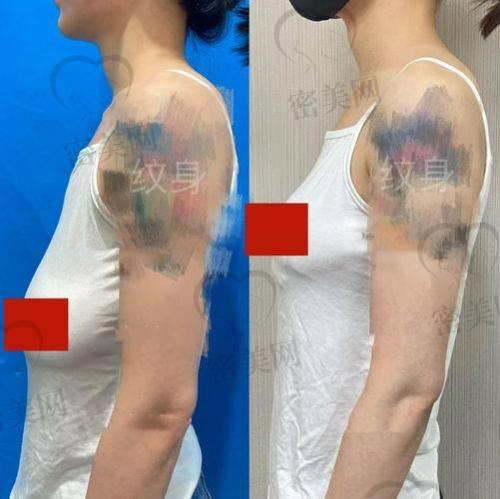 太原美客博仕医疗美容门诊部——刘俊医生雕琢美胸