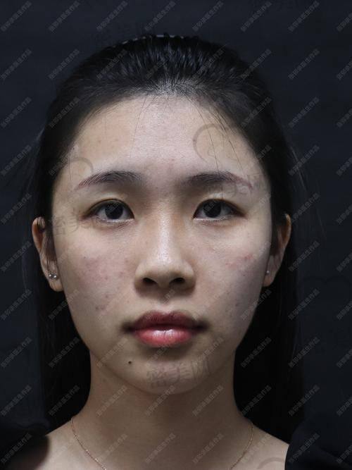 西安米兰柏羽医学美容医院：李闯医生的变得更美奇迹