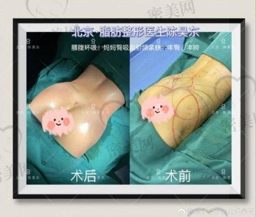 北京雅靓吸脂价格：性价比极高的变得更美选择