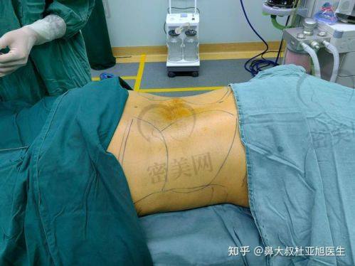 北京雅靓吸脂医生实力大揭秘