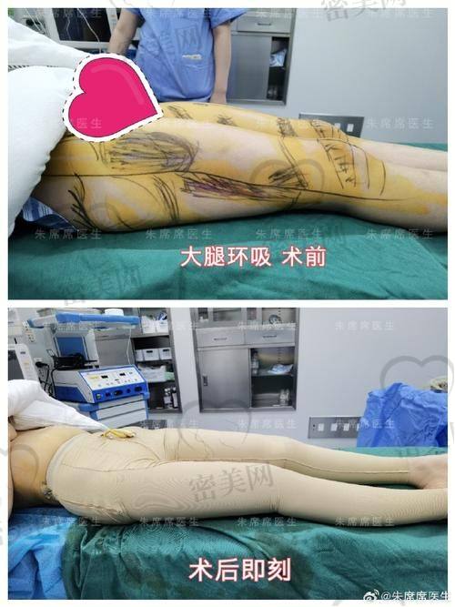 北京雅靓医疗美容医院：吸脂界的“潜力股”？
