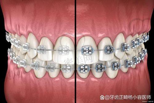 清华阳光口腔医院传统金属托槽矫正价格解析