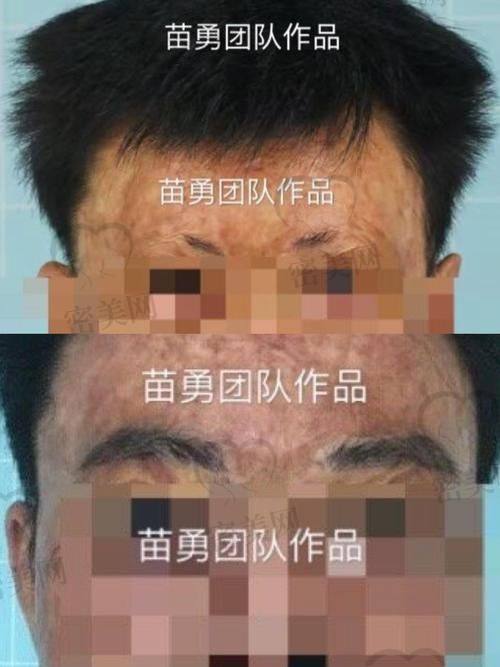 上海美莱医疗美容：王勇医生打造个性眉形