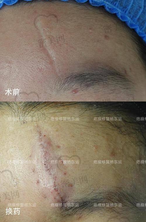 南京鼓楼医院整形美容科——谭谦医生的祛疤绝技