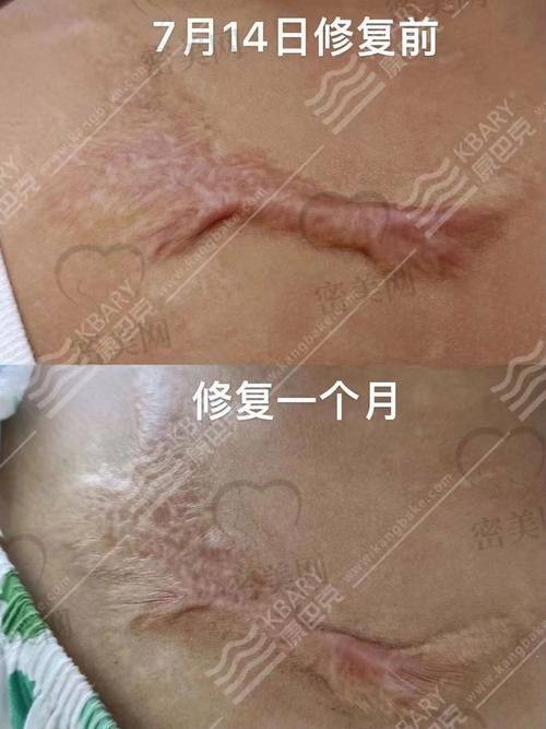 南京艺星医疗美容医院——陈成医生的祛疤秘籍