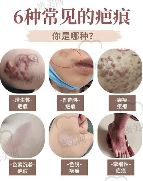 南京维多利亚美容医院——周旭刚医生的祛疤奇术