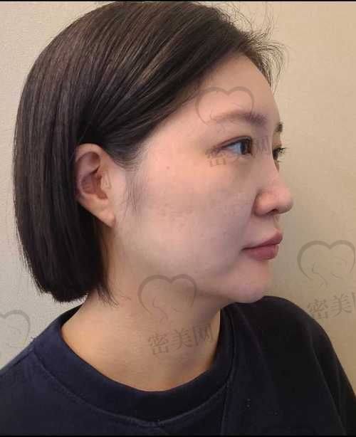 填充成效能维持多久？