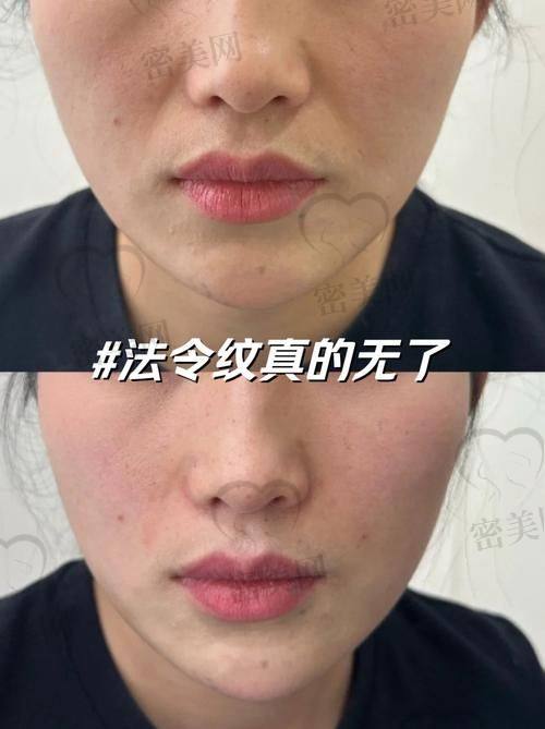 填充后注意事项全揭秘