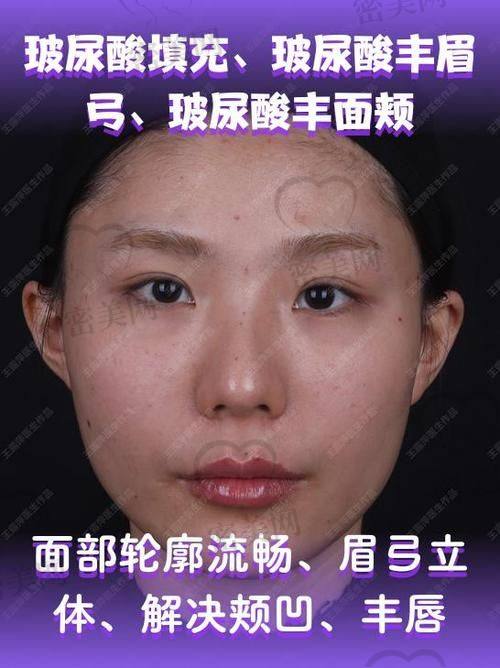 填充前后的注意事项