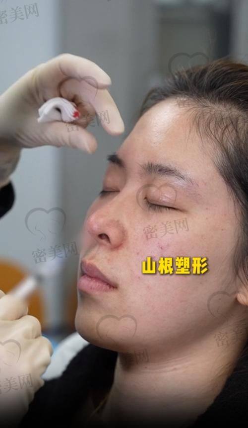 填充不同部位能维持多久？