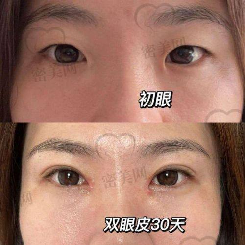 口碑爆棚：丽丽眼综合的魅力无法挡