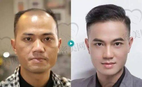 大同京城皮肤医院植发科：正规资质，科室成熟，技术稳扎稳打