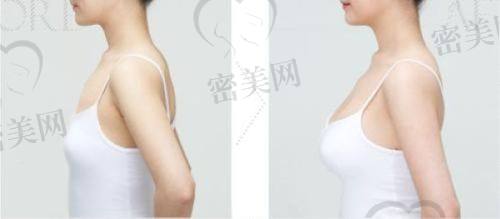 技术优势大比拼：北京美莱高超 VS 艺星于双全