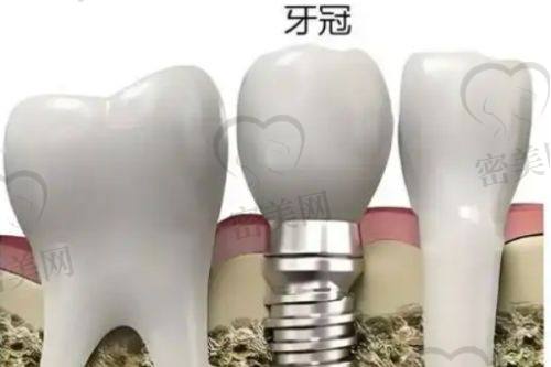牙齿种植的隐形支出：术前术后服务费用全方面解析