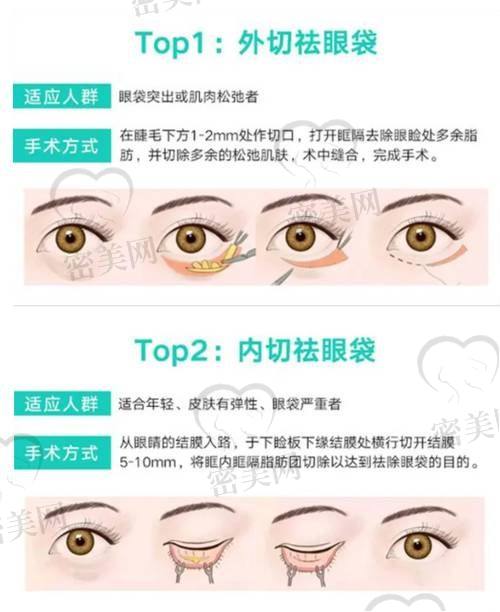 北京吴焱秋做双眼皮修复贵吗？收费标准大揭秘