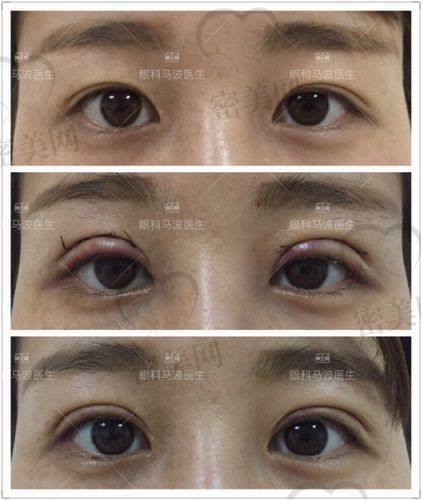 北京吴焱秋双眼皮修复实例视频分享：医生信息大揭秘
