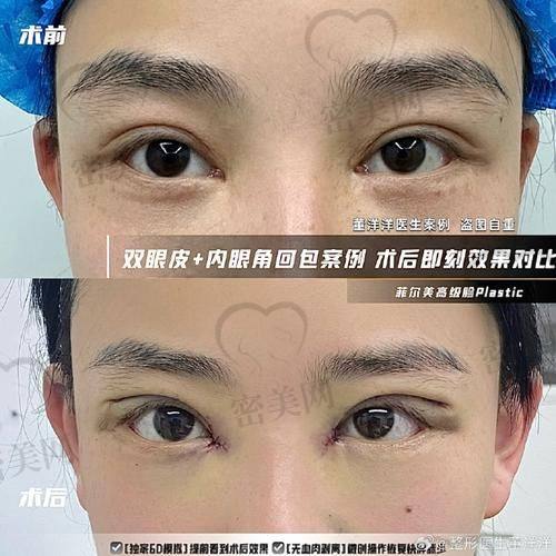 北京吴焱秋做双眼皮修复，收费标准咋样