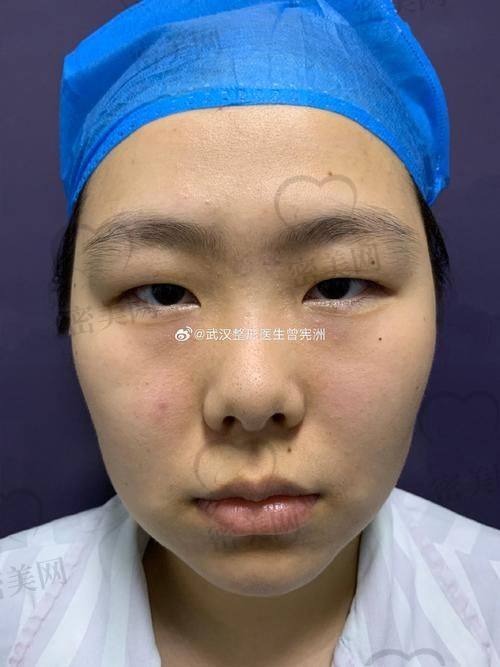 北京吴焱秋双眼皮修复实例视频分享：专精能力超名列前茅