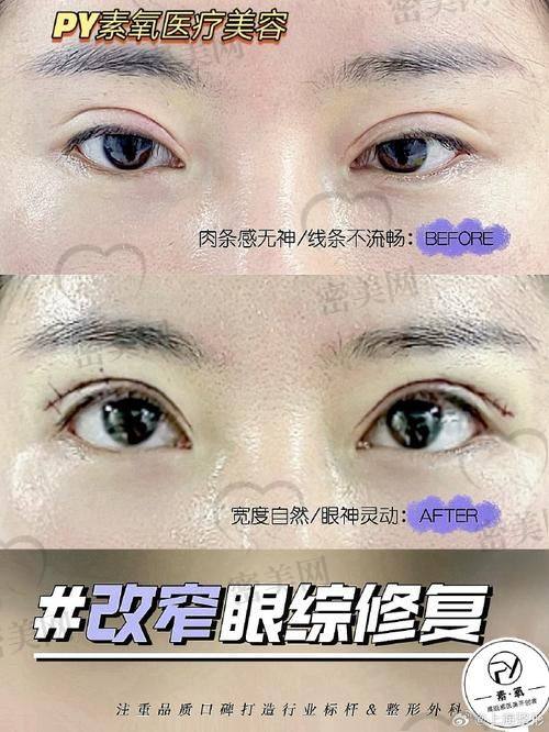 北京吴焱秋做双眼皮修复，口碑到底好不好