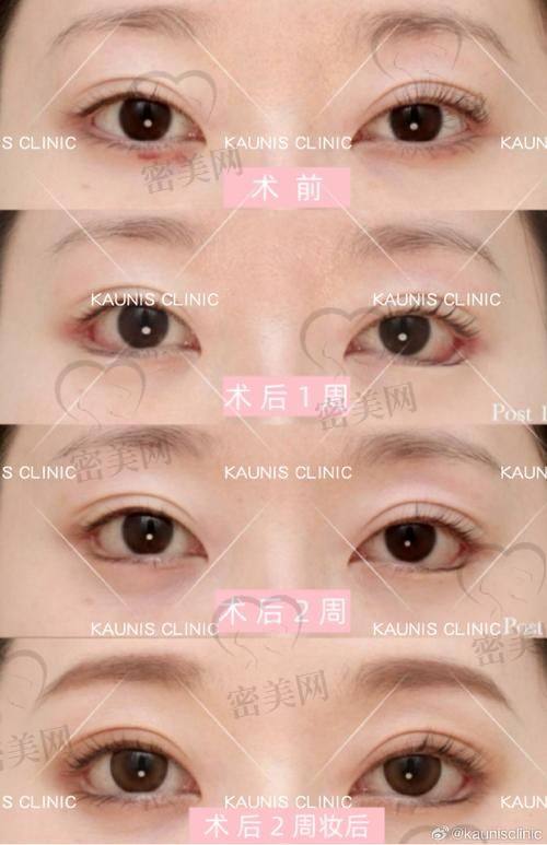 吴焱秋大夫修复双眼皮成效揭秘