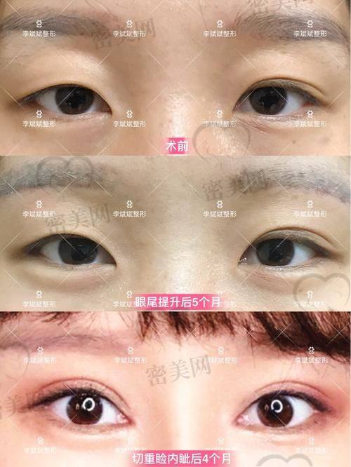 北京吴焱秋做双眼皮修复，专精能力如何