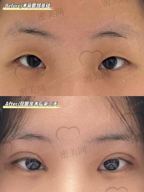 北京吴焱秋医生真实实例超惊艳
