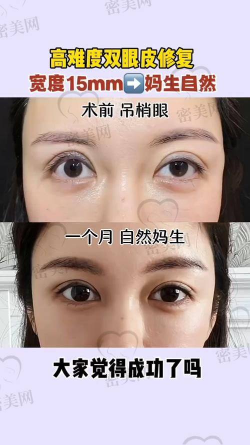 北京丰联丽格：切开双眼皮的优质之选