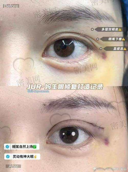 王冀耕医生：埋线双眼皮界的“魔法大师”