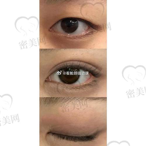 北京丰联丽格医疗美容王冀耕埋线双眼皮：真人实例大公开