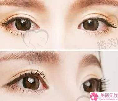 北京丰联丽格医疗美容：埋线双眼皮的梦幻城堡