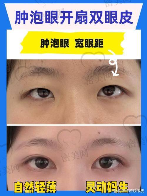 真人实例：北京丰联丽格王冀耕眼综合的神奇魔法