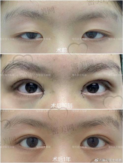 北京丰联丽格医疗美容王冀耕埋线双眼皮：口碑爆棚啦