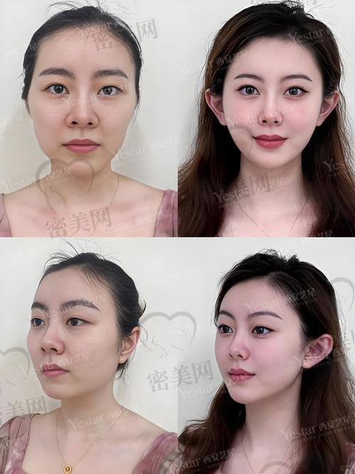 北京美莱王志强的面部再生材料是什么？收费标准大揭秘