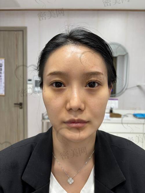 北京美莱王志强手术实例：真实成效看得见