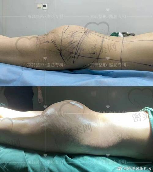 深圳富华医疗美容医院——高静医生的抽脂秘籍