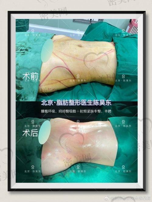深圳美加美医疗美容门诊部——王洪医生的抽脂妙手