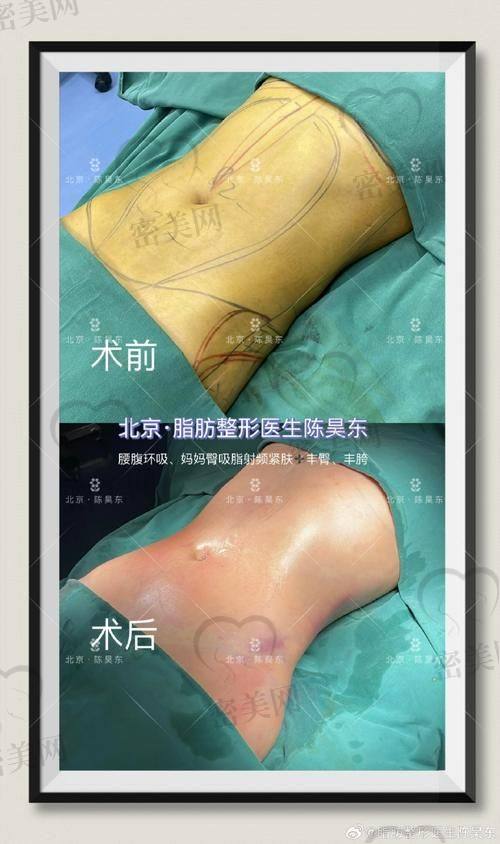 深圳阳光医疗美容医院——罗志敏医生的抽脂魅力