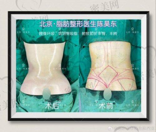 深圳军科医疗美容门诊部——刘月更医生的抽脂风采