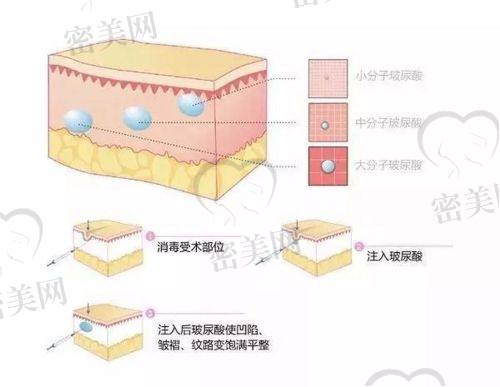 法令纹填充的风险与注意事项