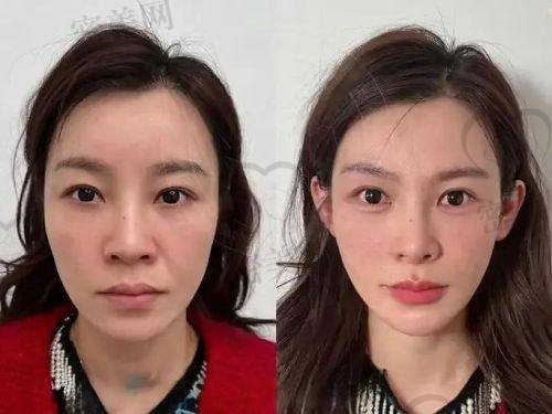 填充成效能维持多久