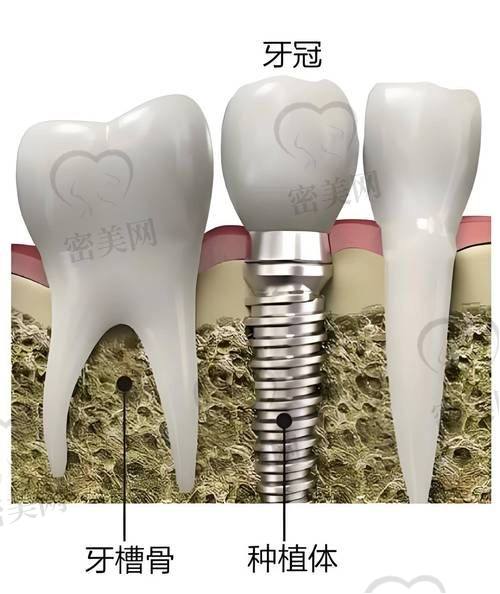 小贴士：适合什么类型患者选择正恩？