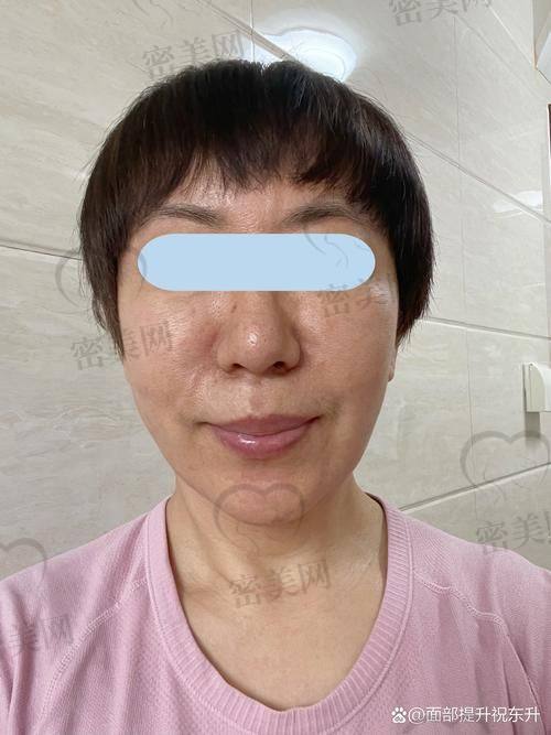 北京美莱王志强手术实例：真实成效看得见