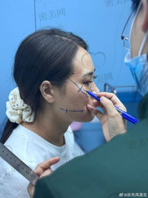 法令纹埋线保持时间：能年轻多久？